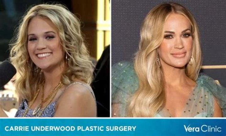 
Carrie Underwood Face Before And After Accident: Photos & Injury Explained 