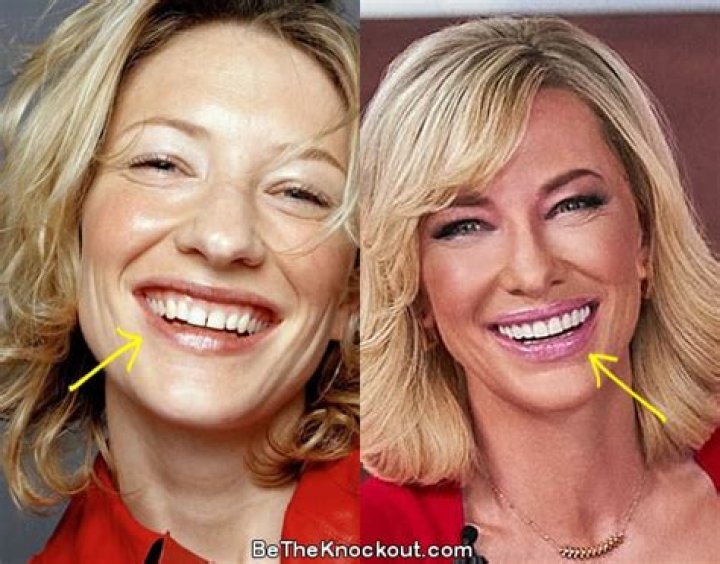 Cate Blanchett Plastic Surgery And Teeth Veneers – Fake Tooth Photos
