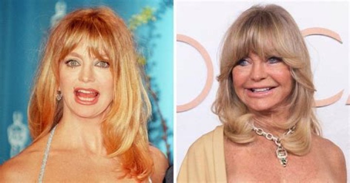 Did Goldie Hawn Undergo Plastic Surgery? Learn About Goldie Hawn - SarkariResult